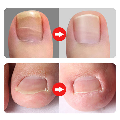 Professional Ingrown Toenail Clipper 7-Piece Set