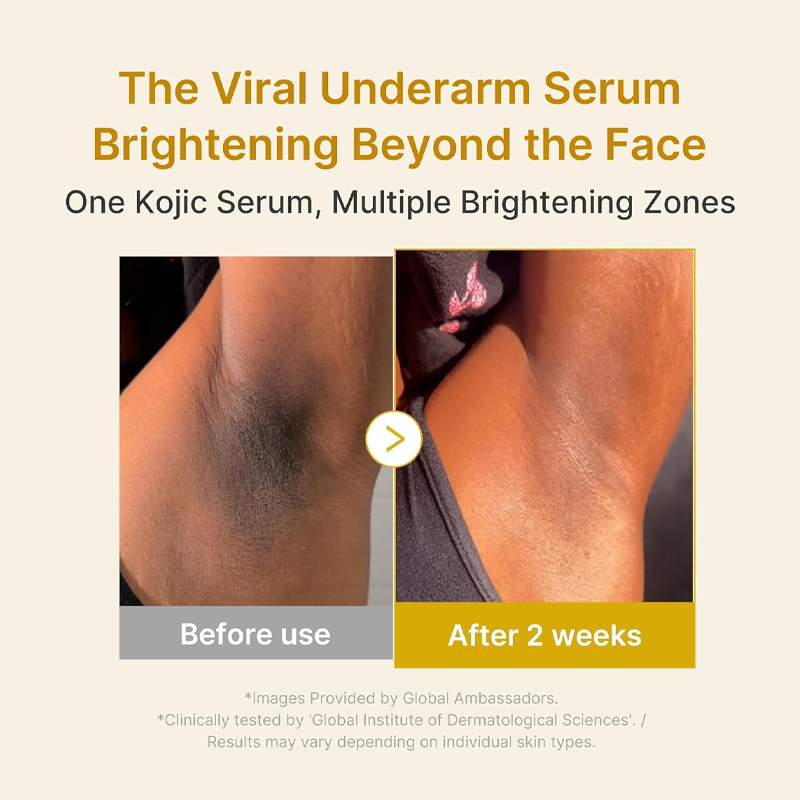 🥳2026 HOT SALE🥳💞50K+ SOLD!💫🌼 50% OFF! Kojic Acid Turmeric Brightening Serum – Fades dark spots, evens tone, soothes redness. Lightweight & gentle for daily use. ✨🌸