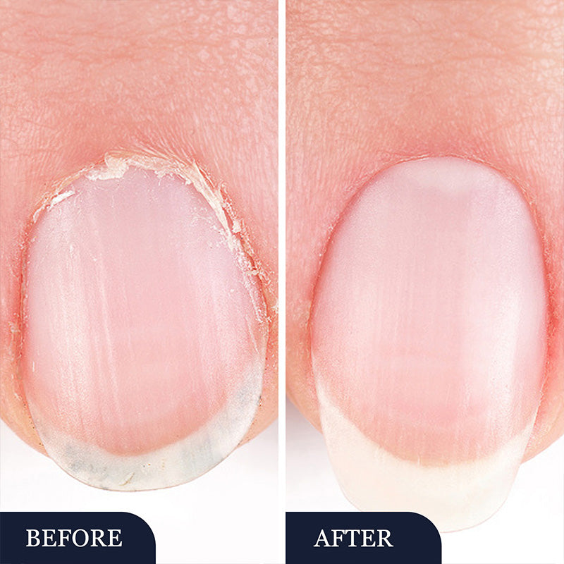 🥳2026 HOT SALE🥳💞50K+ SOLD!🔄💚 50% OFF! Toenail Fungus Pen – Targets nail bed, promotes healthy regrowth. No mess, on‑the‑go treatment. A step to beautiful nails. 🌟🦶