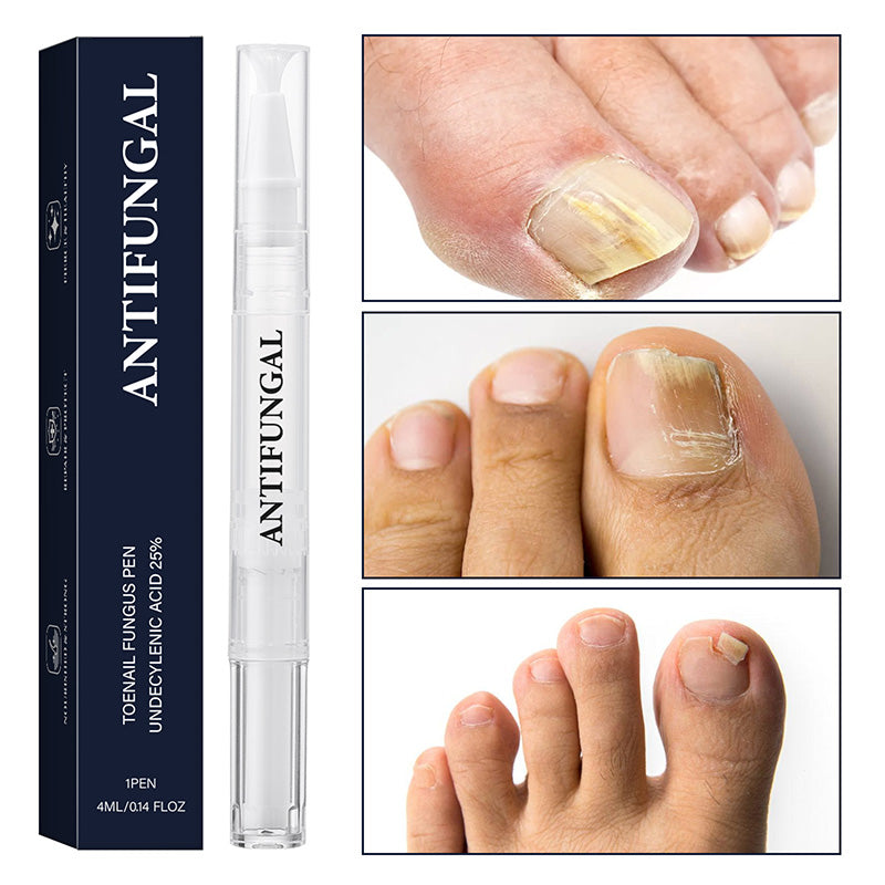 🥳2026 HOT SALE🥳💞50K+ SOLD!🔄💚 50% OFF! Toenail Fungus Pen – Targets nail bed, promotes healthy regrowth. No mess, on‑the‑go treatment. A step to beautiful nails. 🌟🦶