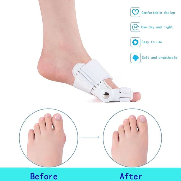 🥳2026 HOT SALE🥳💞50K+ SOLD!🦶✨ 50% OFF! Bunion Corrector – Relieves toe pain, realigns joints. Wear day or night. For men & women. 🛡️💪
