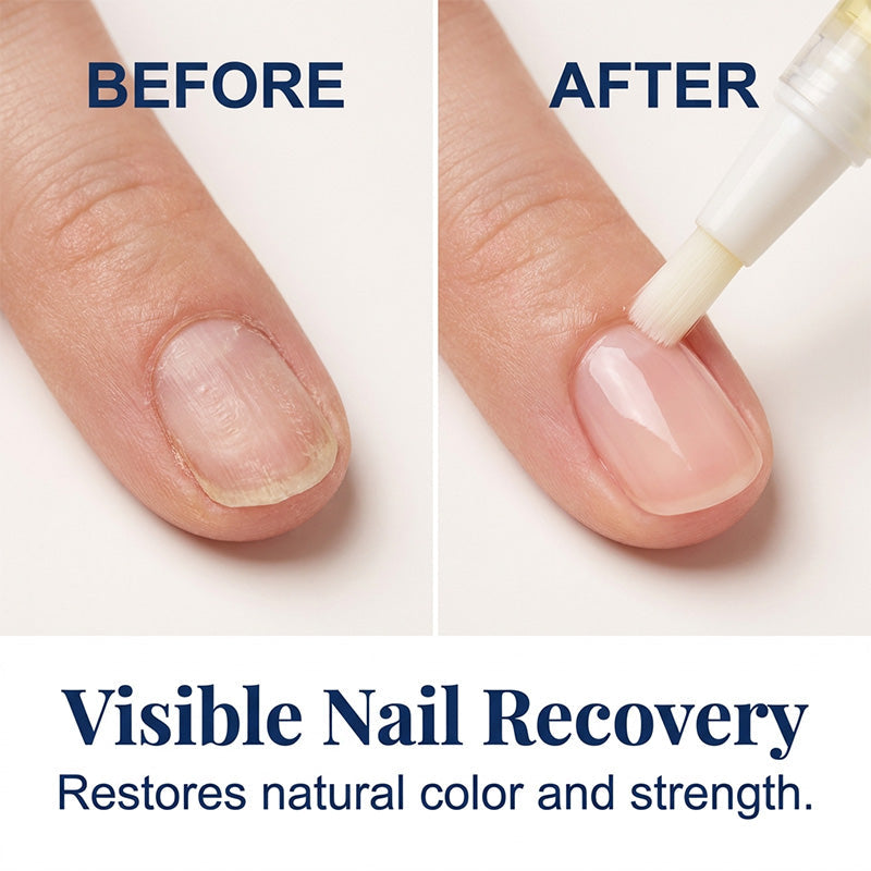 🥳2026 HOT SALE🥳💞50K+ SOLD!🌸🛡️ 50% OFF! Nail Recovery Pen Set – 7 pens + 7 files. Targets yellow, weak nails. Leak‑proof, perfect for purse. Say goodbye to ugly nails! 💪✨