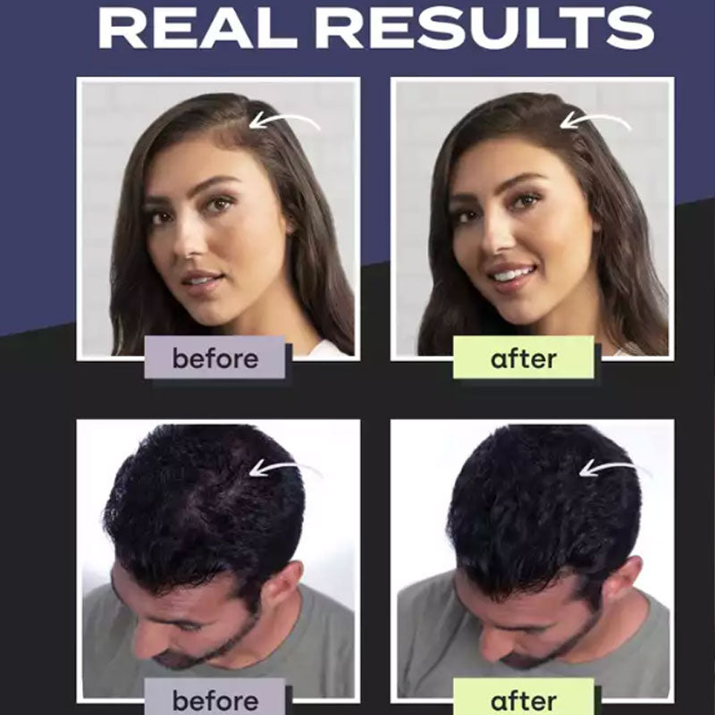 🥳2026 HOT SALE🥳💞50K+ SOLD! 🧔✨ 50% OFF! Hair Building Fibers Set – Instantly covers thinning areas & bald spots. Natural-looking results, easy to apply & wash out with shampoo! 🛁✅